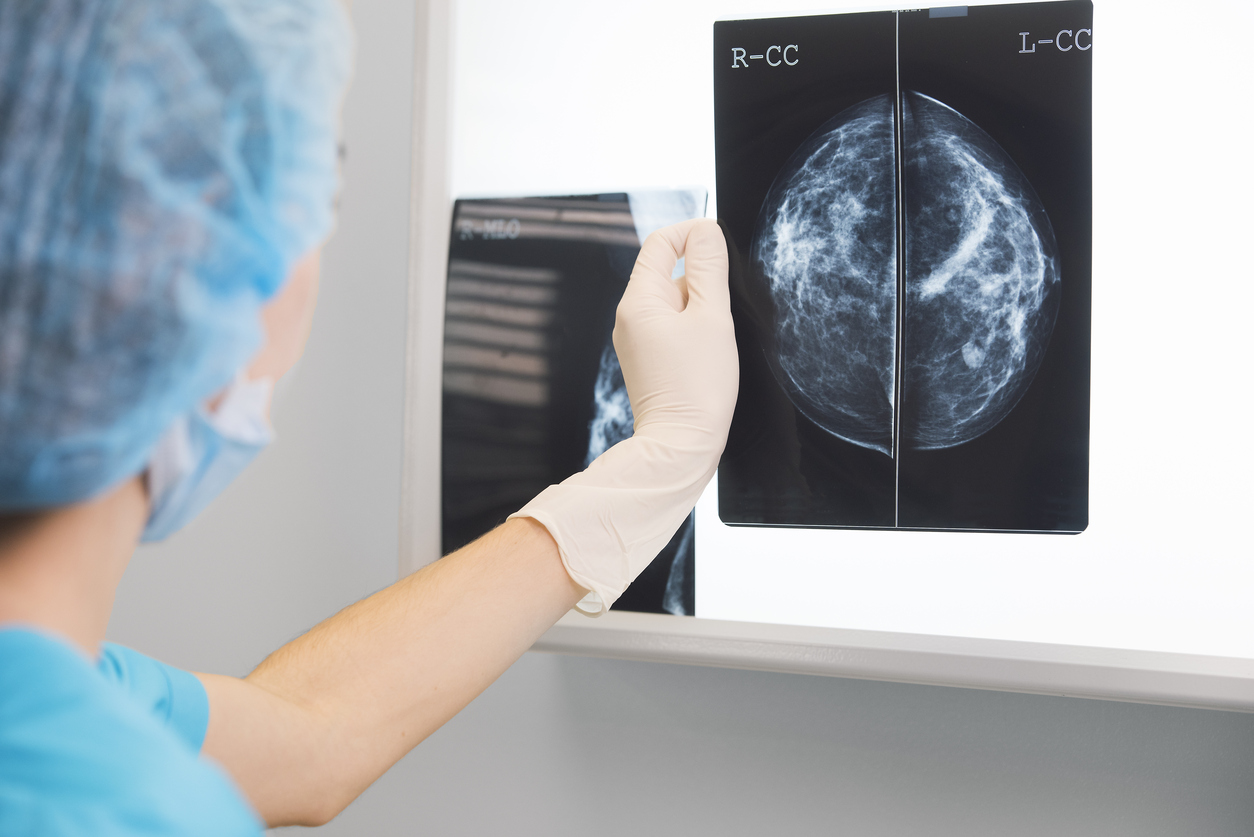 Women offered NHS breast screening after missed invitations