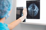 Women offered NHS breast screening after missed invitations